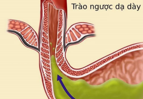 Biến chứng nào xảy ra nếu bệnh trào ngược dạ dày thực quản không được điều trị sớm